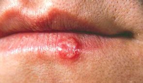 photo of a cold sore